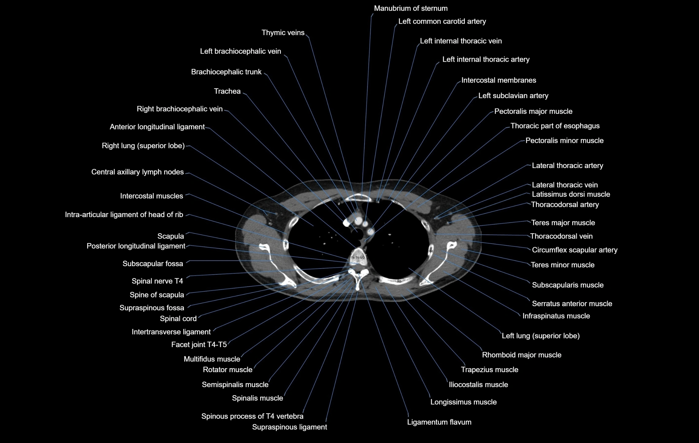 CT chest (thorax) labelled axial cross sectional anatomy radiology image-00030.webp